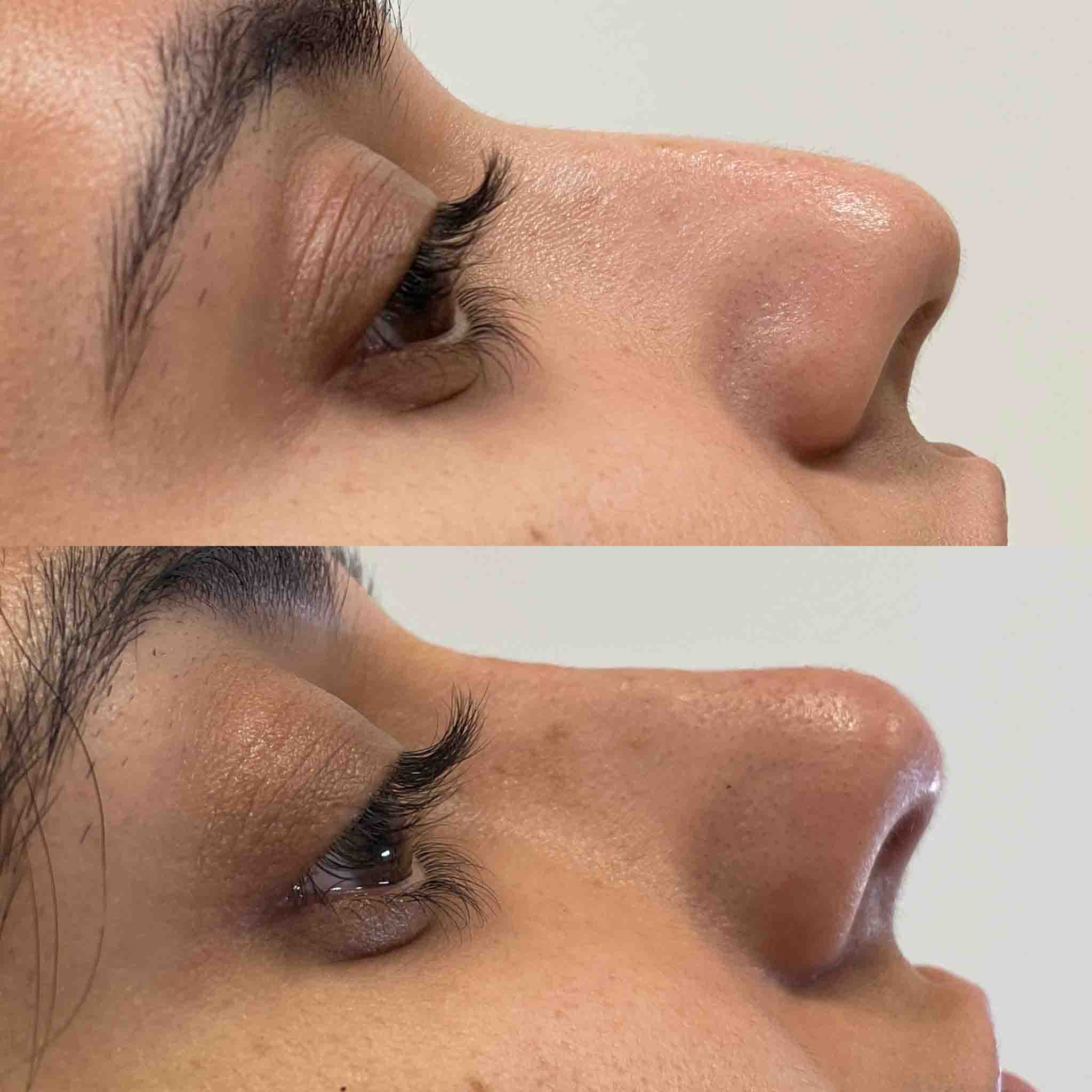 Before and after of liquid rhinoplasty in Los Gatos