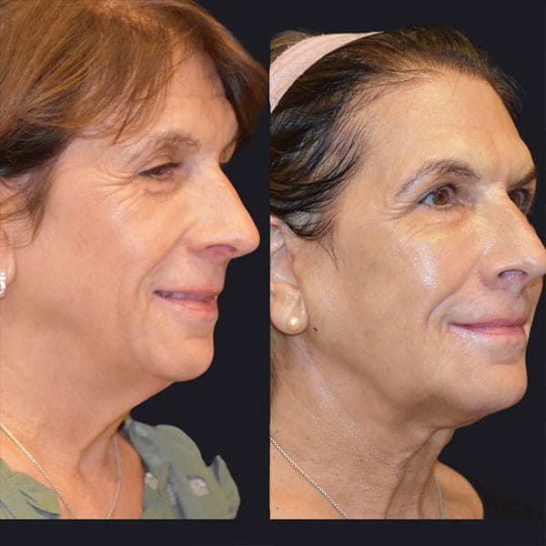 woman before and after facial fat grafting in Los Gatos