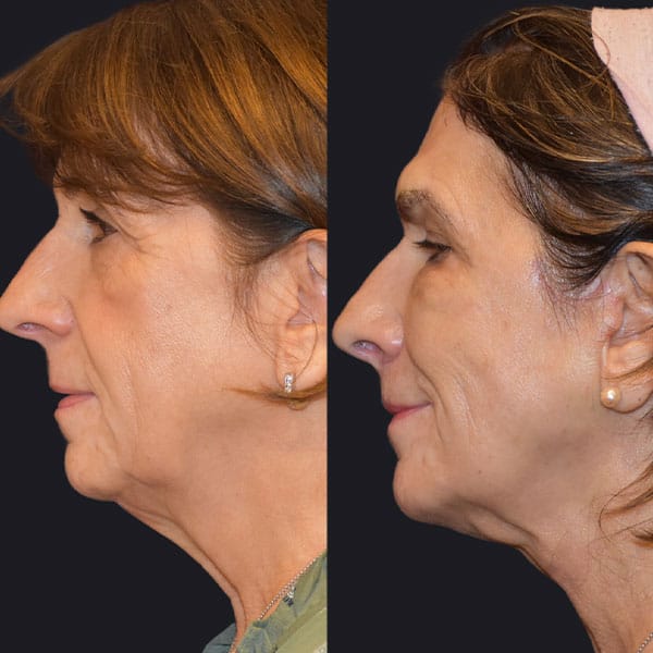 woman before and after facial fat grafting in Los Gatos