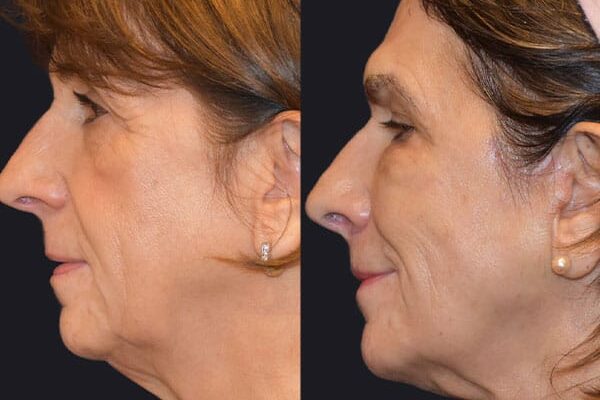 woman before and after neck lift in Los Gatos