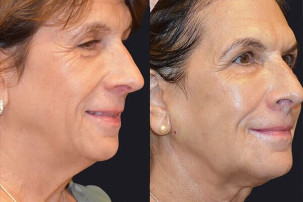 woman before and after facelift in Los Gatos