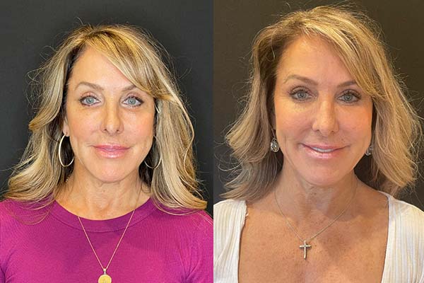 facial-fat-grafting-ba-3-a