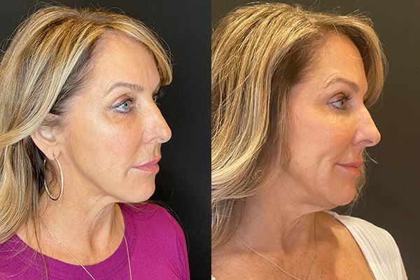 facial-fat-grafting-ba-3-b
