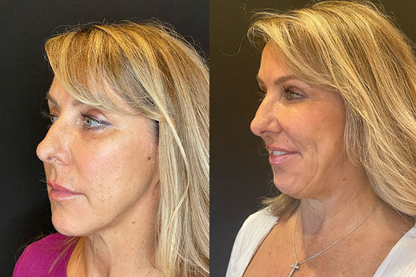 facial-fat-grafting-ba-3-d