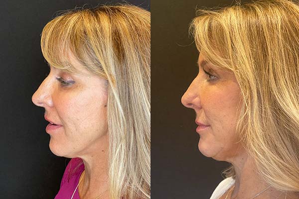 facial-fat-grafting-ba-3-e