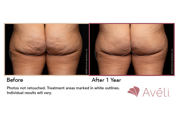 aveli-cellulite-treatment-subpage-ba-1