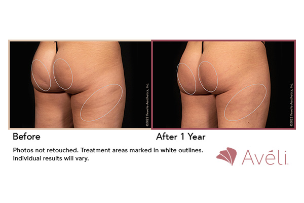 aveli-cellulite-treatment-subpage-ba-2
