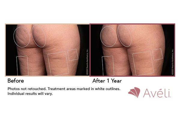 aveli-cellulite-treatment-subpage-ba-3