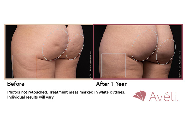 aveli-cellulite-treatment-subpage-ba-5