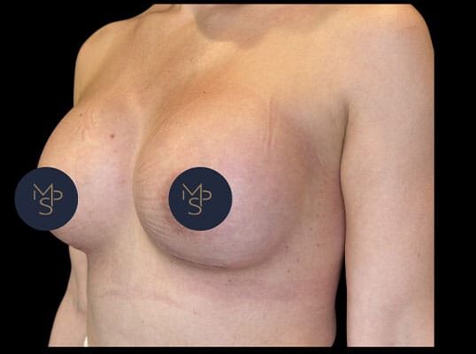 Breast-Augmentation-2-after Breast-Augmentation-2-after